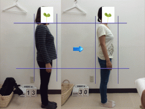 産後の猫背が大幅改善。画像あり