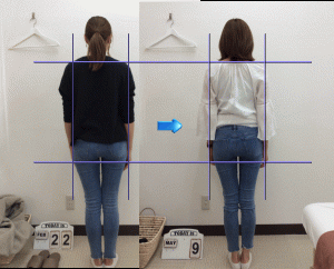 歩行の外ねじれが減少