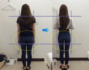 産後骨盤矯正ビフォーアフター画像