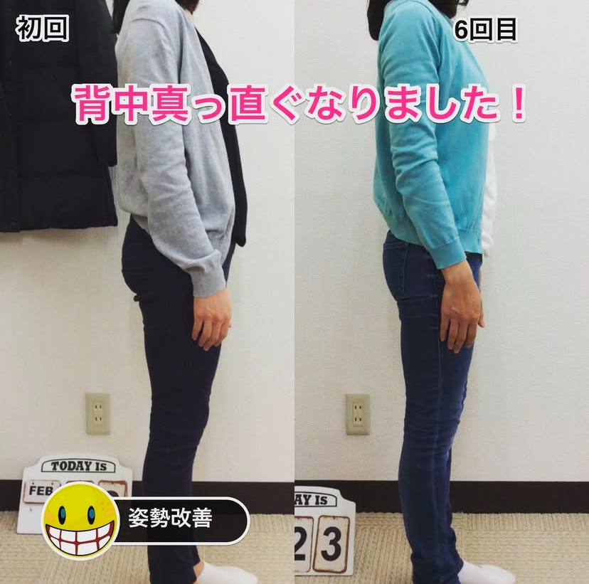 骨盤矯正と神経調整後、自然な姿勢と腰の安定感を取り戻した女性の施術後写真