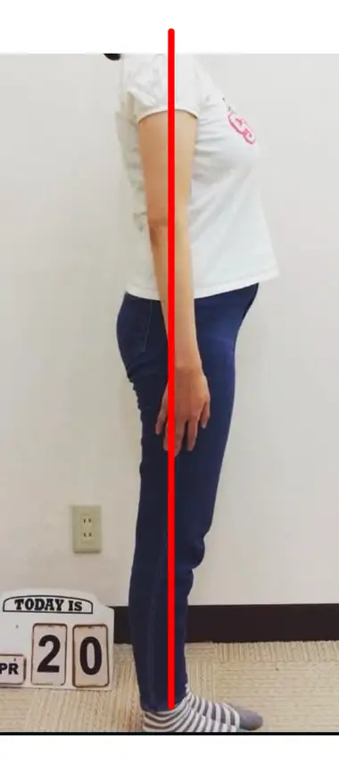 猫背・巻き肩の施術前写真｜背中が丸まり肩が前に出た状態