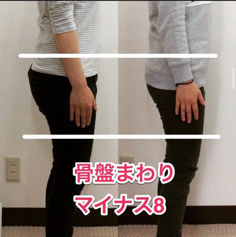 骨盤まわりマイナス8cmのビフォーアフター写真｜姿勢改善で頭痛にも効果