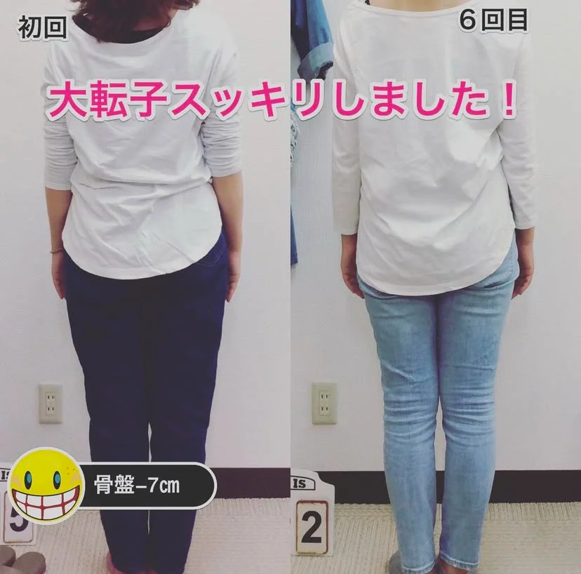 "産後骨盤矯正のビフォーアフター写真|姿勢の変化がわかる実例"