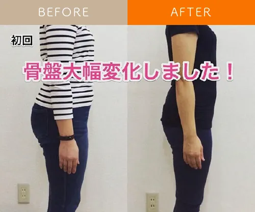猫背と反り腰の姿勢が骨盤矯正によって整い、お腹まわりが引き締まったビフォーアフター写真（姿勢改善例）