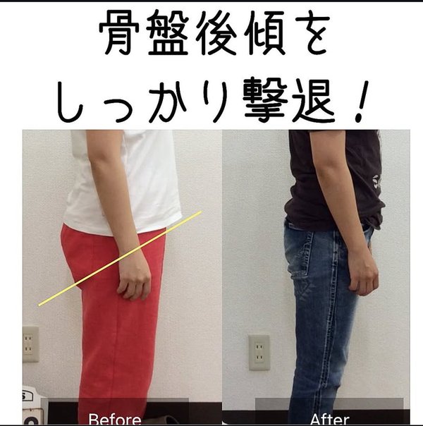 脚のねじれが整い骨盤ラインがスッキリしたビフォーアフター