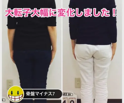 骨盤矯正によって大転子の出っ張りが内側に引き締まり、後ろ姿のヒップラインが変化したビフォーアフター写真