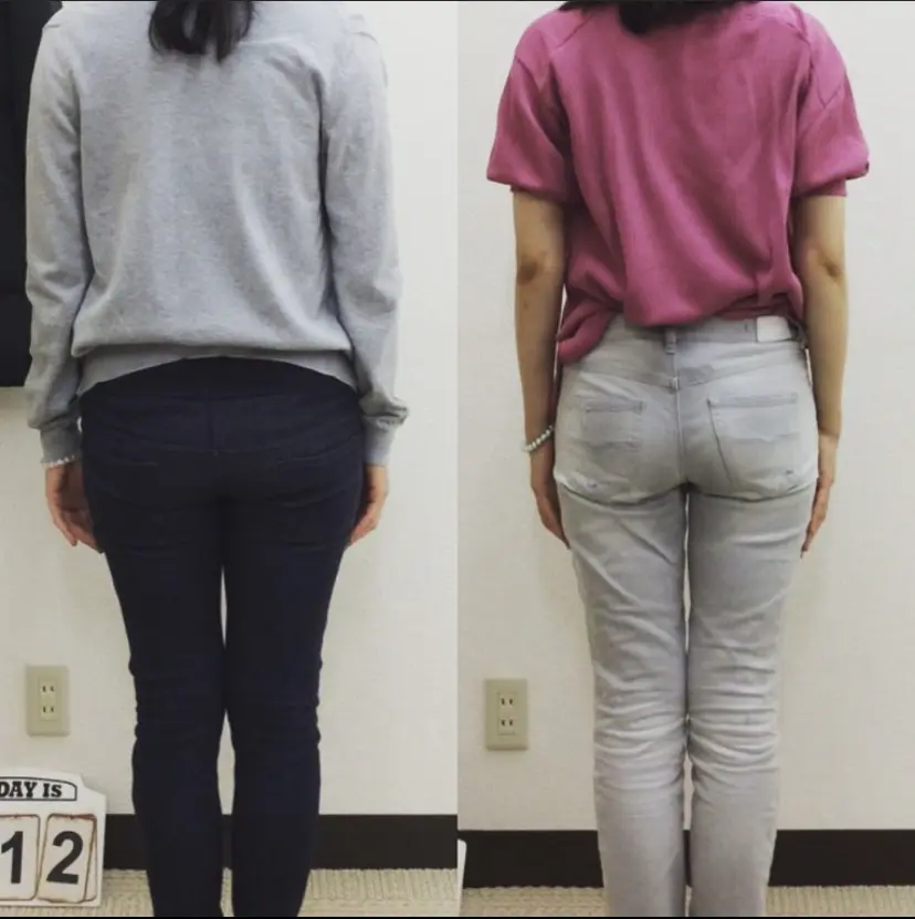 産後骨盤矯正を数回受けた後の後ろ姿。骨盤が引き締まり、お尻の形が整い始めている様子