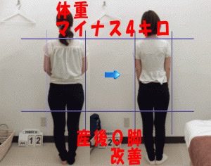 大転子改善したビフォーアフター