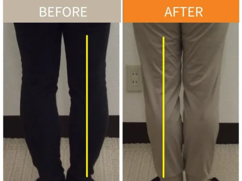 大転子 ビフォーアフター