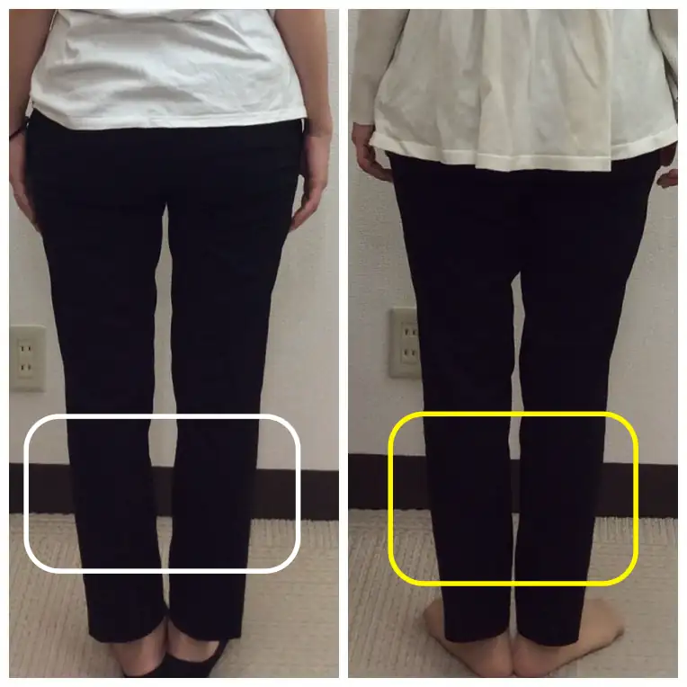 産後O脚のビフォーアフター写真（脚のラインの変化）